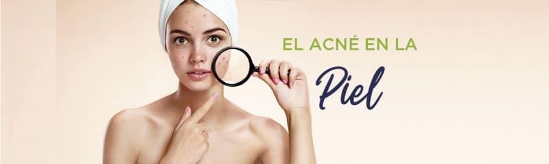 El acné en la piel
