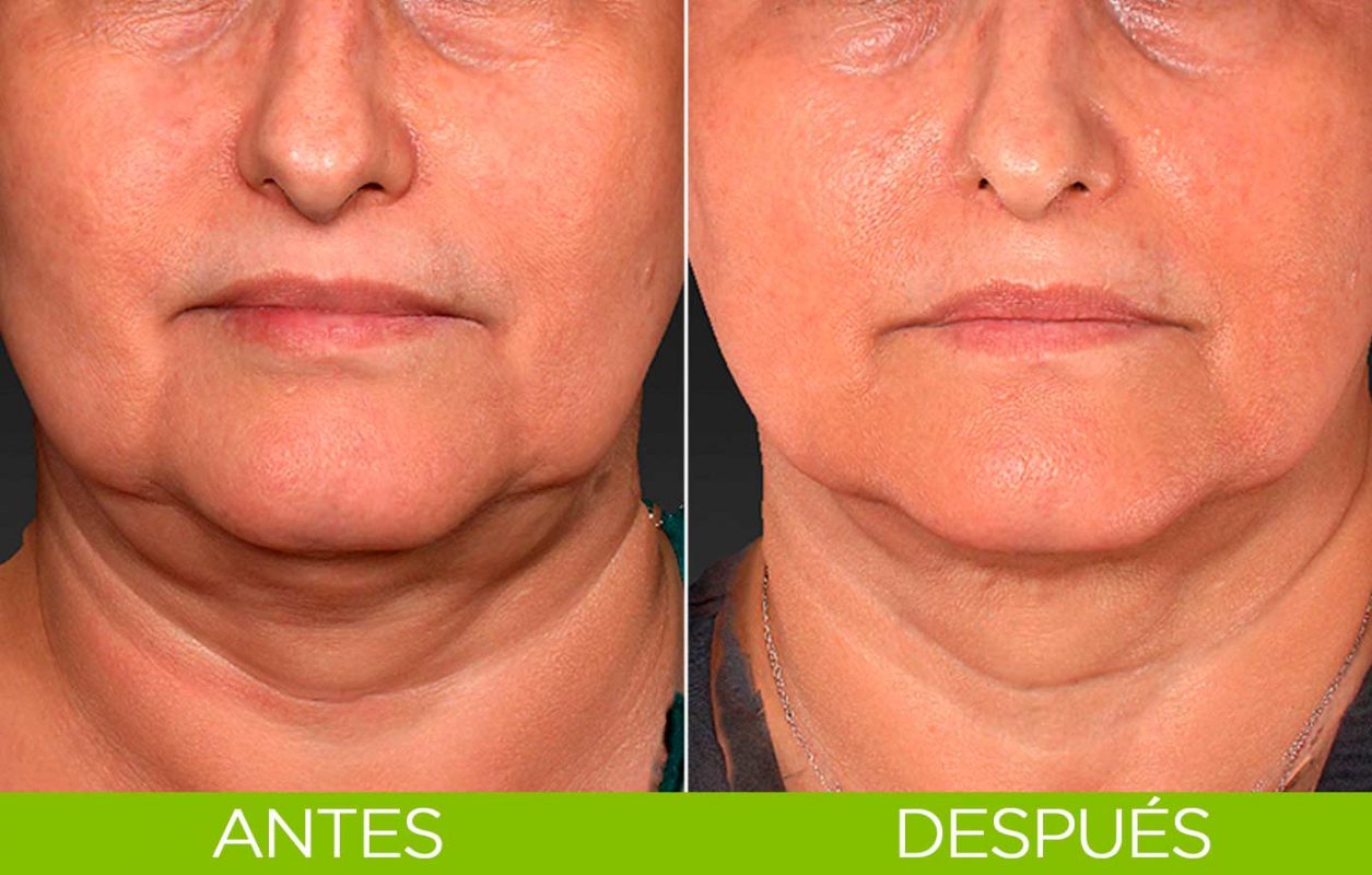 elimina-papada-sin-cirugia
